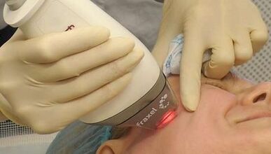 Как се извършва фракционното подмладяване на кожата