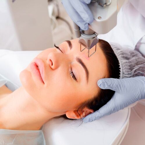 Процедура фототермолиза за подмладяване на кожата на лицето