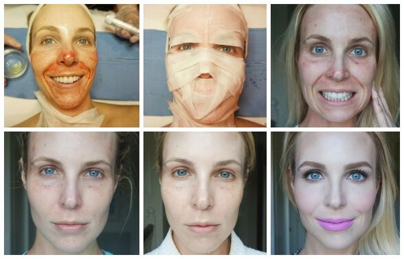 Етапи на заздравяване на кожата на лицето след успешен плазмолифтинг