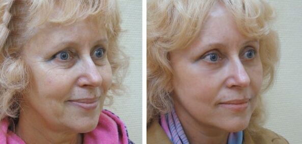 Жена преди и след плазмено подмладяване на кожата на лицето