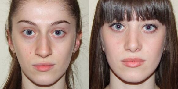 Момиче преди и след плазмено подмладяване на кожата на лицето